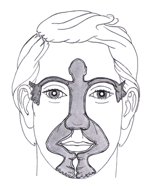 Gesicht mit den eingezeichneten Behandlungszonen bei Dien-Cham